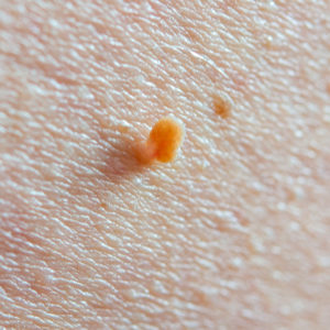 Skin Tags Removal