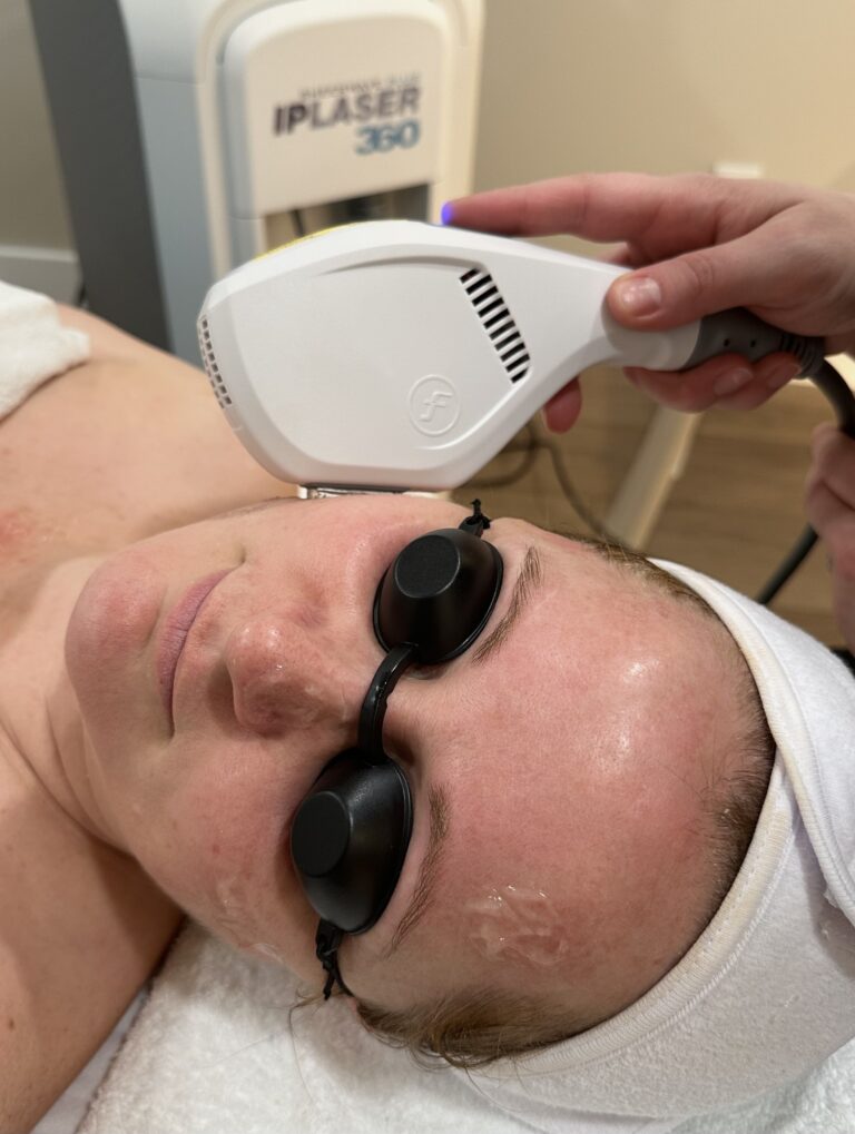 Is IPL / Photorejuvenation Right for you?